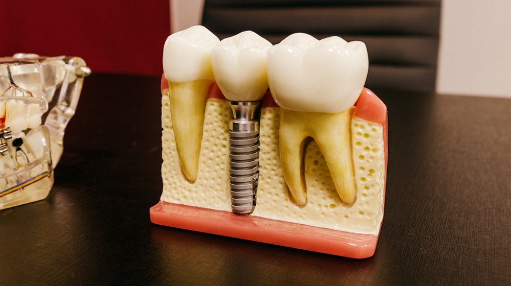 dental implant treatment-929dd50c